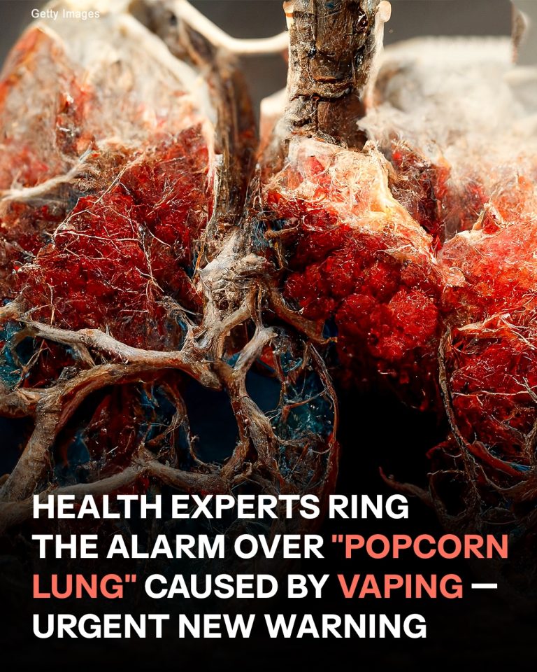 Experts Ring the Alarm Over ‘Popcorn Lung’ Caused by Vaping — Details