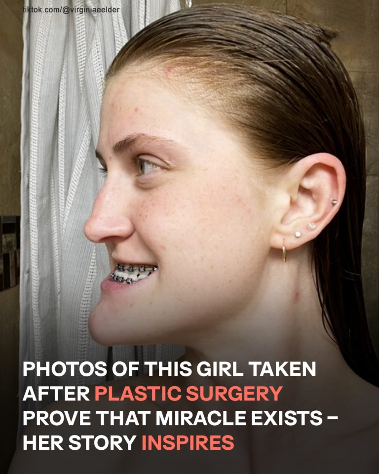 This Girl Underwent Double Jaw Surgery — Before-and-After Photos Left Everyone Speechless