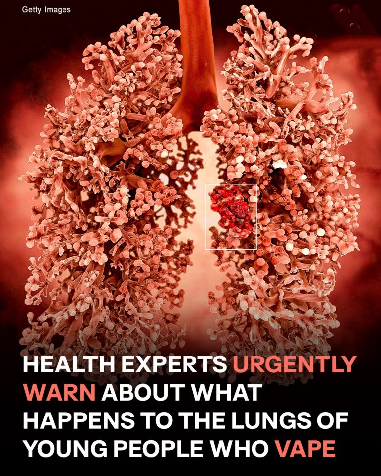 Experts Ring the Alarm Over ‘Popcorn Lung’ Caused by Vaping — Details