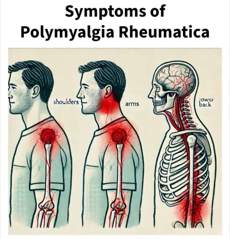 Important Signs To Look For That Could Suggest You Have Polymyalgia Rheumatica