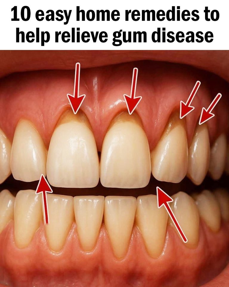 10 Simple Remedies to Help Relieve Gum Disease At Home