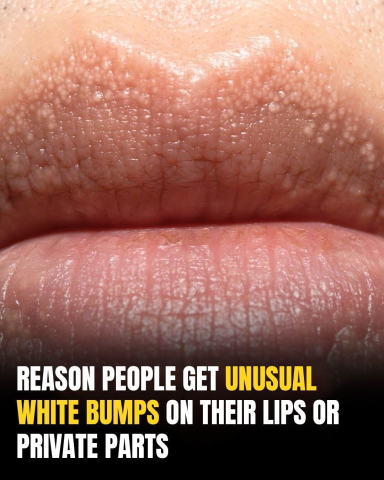 What Are Those White Bumps That Can Appear On Your Private Parts and What Causes Them?
