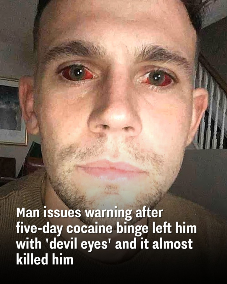 Man issues warning after five-day cocaine binge left him with ‘devil eyes’ and it almost killed him