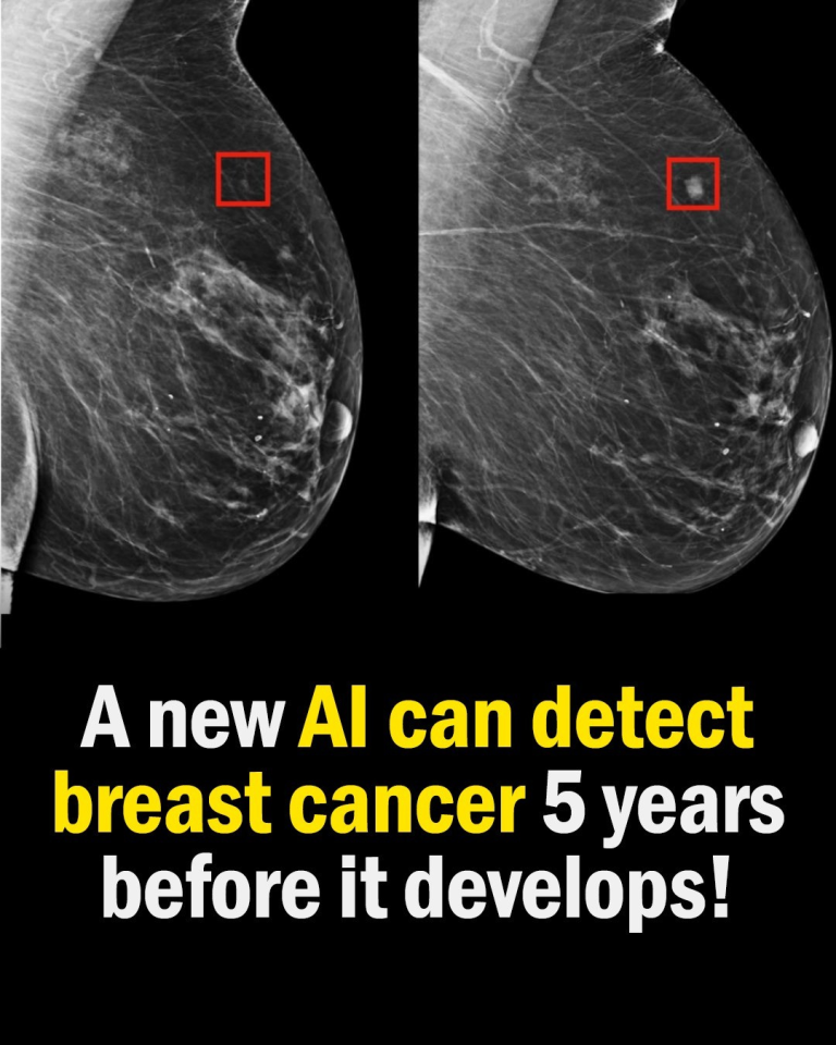 “Mirai: Revolutionary AI Model for Early Breast Cancer Detection”