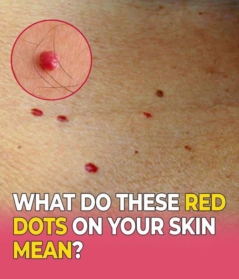 11 Reasons Why You Have Red Dots On Your Skin