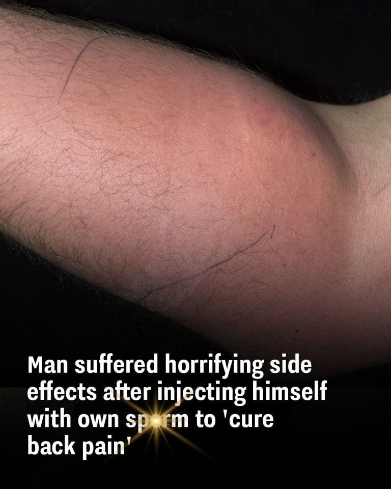 Man suffered horrifying side effects after injecting himself with own sperm to ‘cure back pain’